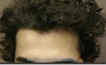 Hair restoration procedure results