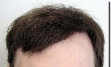Hair restoration procedure results