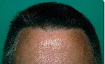 Hair restoration procedure results