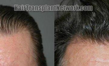Front view of hair transplant, before and after
