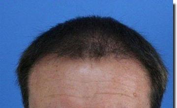 Hair restoration procedure results