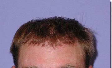 Hair restoration procedure results