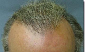 Hair restoration procedure results