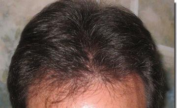 Hair restoration procedure results