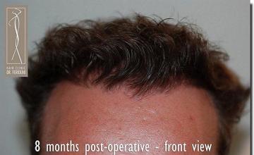 Hair restoration procedure results