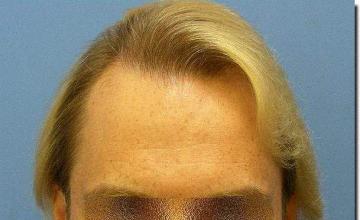 Hair restoration procedure results