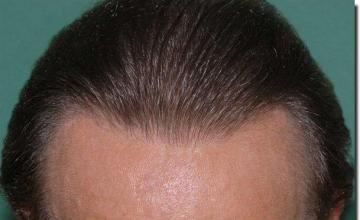 Hair restoration procedure results