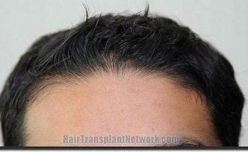 Hair restoration procedure results