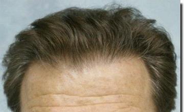 Hair restoration procedure results