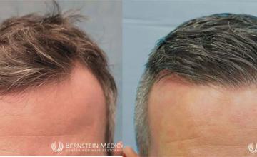 Front - before and after