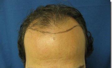 Hair restoration procedure results