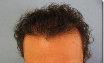 Hair restoration procedure results