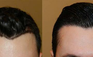 Front - before and after