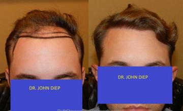 Front - before and after
