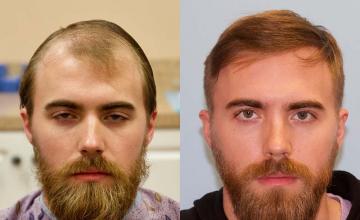 Front - before and after
