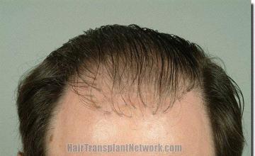 Hair restoration procedure results