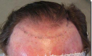 Hair restoration procedure results