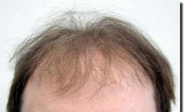 Hair restoration procedure results