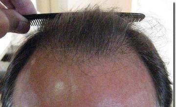 Hair restoration procedure results