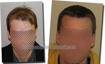 Hair restoration procedure results
