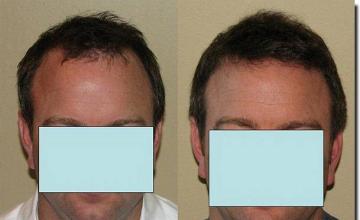 Hair restoration procedure results