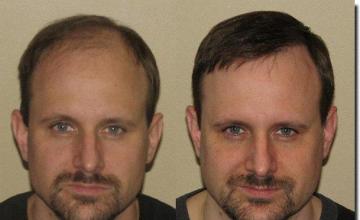 Hair restoration procedure results