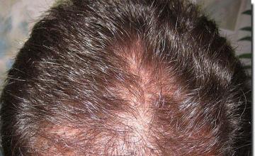 Hair restoration procedure results