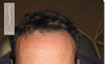 Hair restoration procedure results