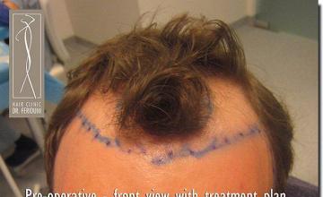 Hair restoration procedure results