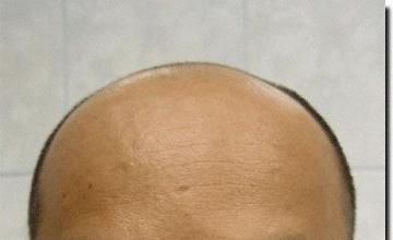 Hair restoration procedure results