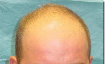 Hair restoration procedure results