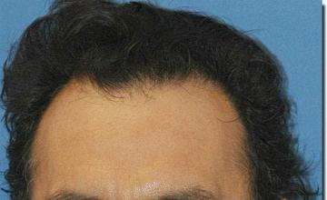 Hair restoration procedure results