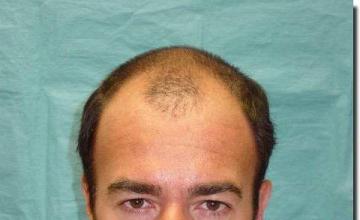 Hair restoration procedure results