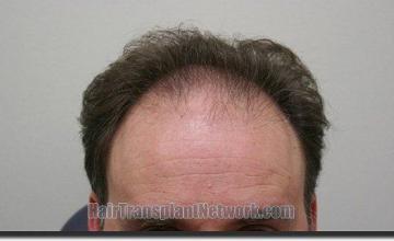 Hair restoration procedure results