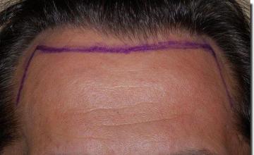 Hair restoration procedure results