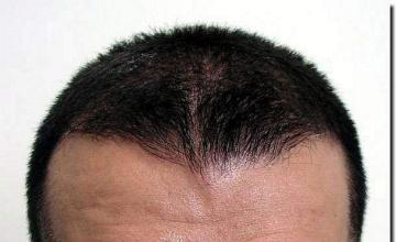 Hair restoration procedure results