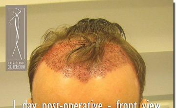 Hair restoration procedure results