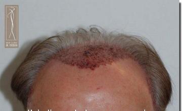 Hair restoration procedure results