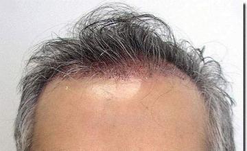 Hair restoration procedure results