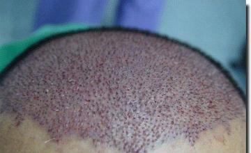 Hair restoration procedure results