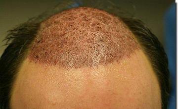 Hair restoration procedure results