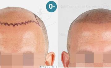 Frontal area planning and immediate post op