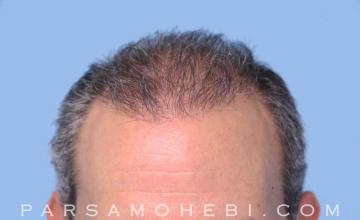 Hair restoration procedure results
