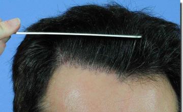 Hair restoration procedure results