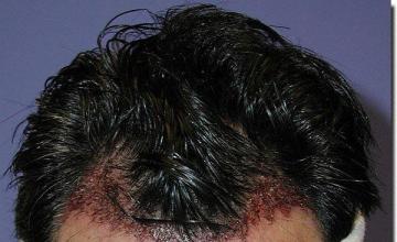 Hair restoration procedure results