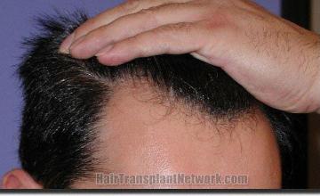 Hair restoration procedure results