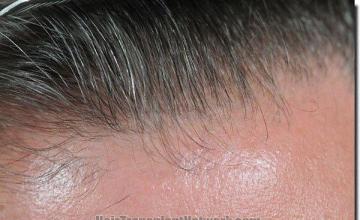 Hair restoration procedure results