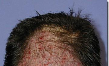 Hair restoration procedure results