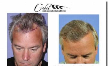 Hair restoration procedure results