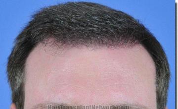 Hair restoration procedure results